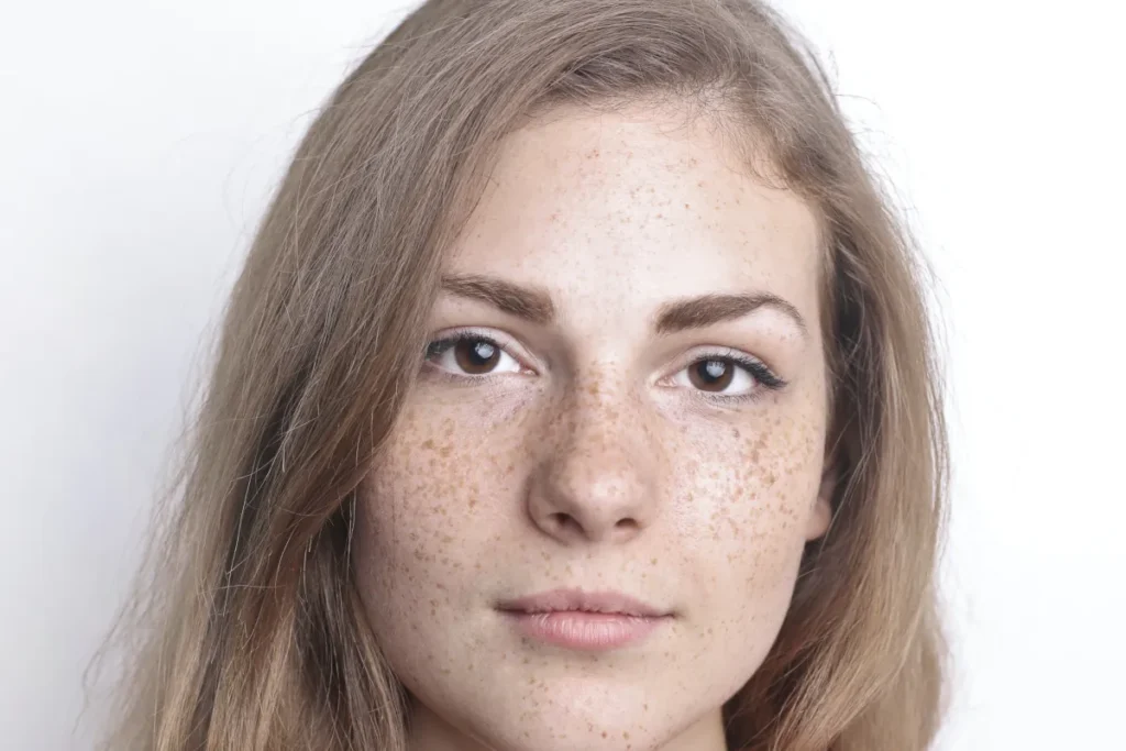 أفضل كريم لعلاج الكلف والتصبغات 2 أفضل كريم لعلاج الكلف والتصبغات