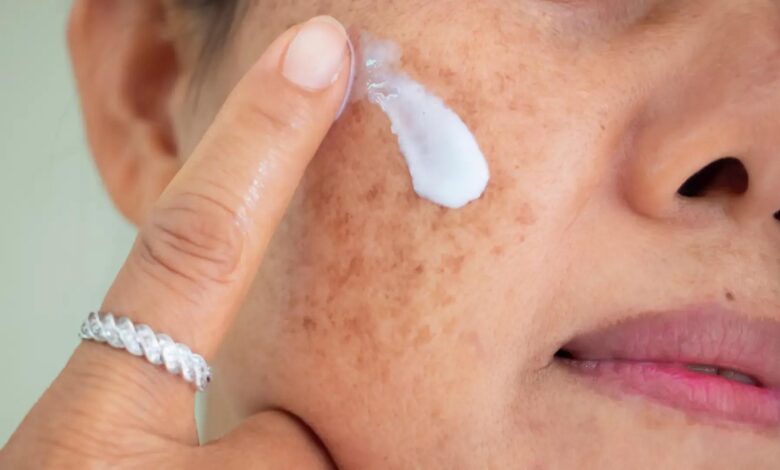 أفضل كريم لعلاج الكلف والتصبغات 1 أفضل كريم لعلاج الكلف والتصبغات