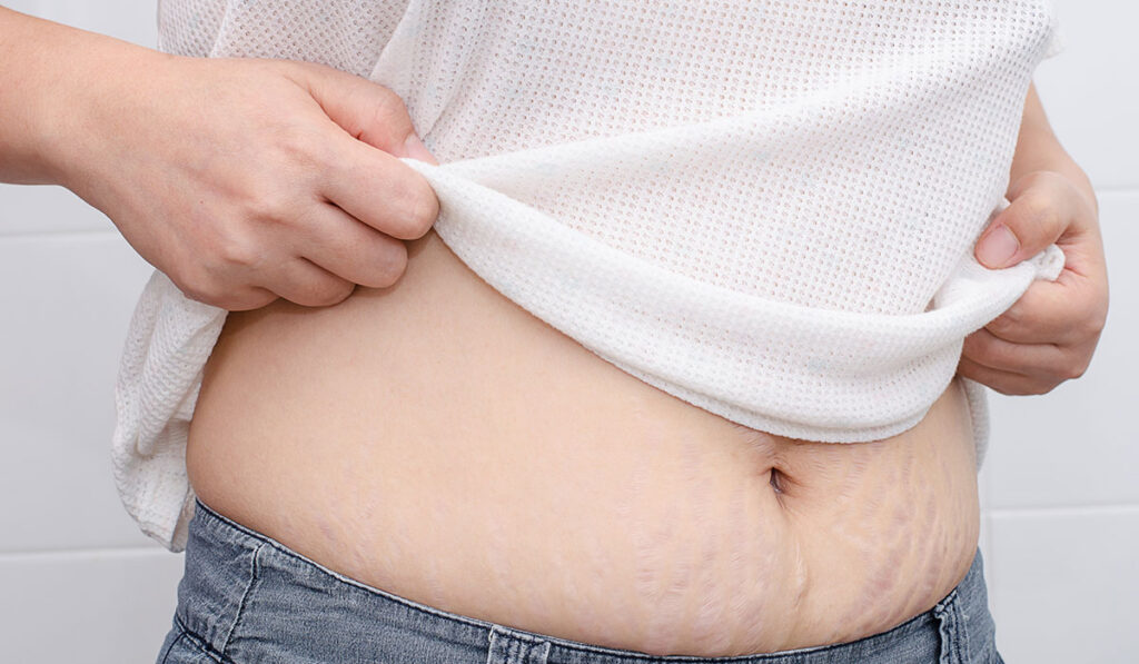 طريقة إزالة السيلوليت والخطوط البيضاء