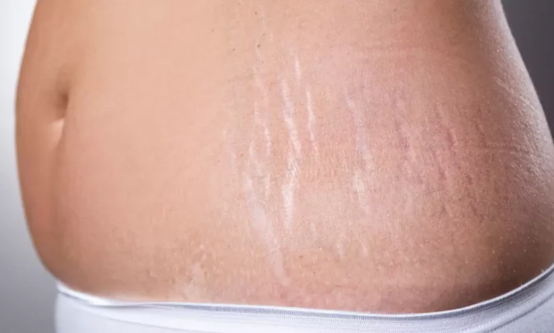 طريقة إزالة السيلوليت والخطوط البيضاء