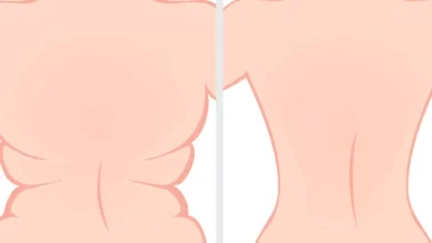 كيف أتخلص من دهون الظهر والأكتاف؟