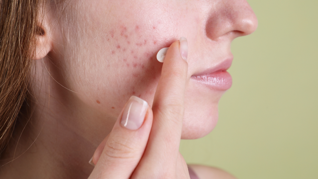 كيفية استعمال حمض الساليسيليك للبشرة 2 كيفية استعمال حمض الساليسيليك للبشرة