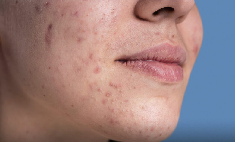 ماذا تحتاج البشرة الدهنية.. أساسيات العناية بالبشرة الدهنية 8 ماذا تحتاج البشرة الدهنية.. أساسيات العناية بالبشرة الدهنية