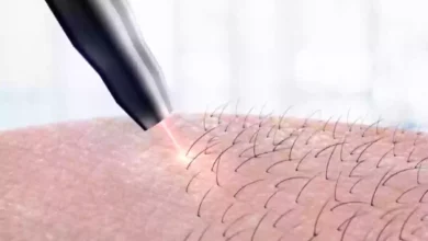 هل الليزر يساعد على تفتيح المناطق الحساسة؟