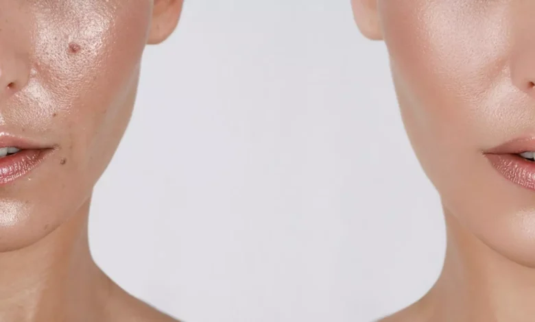 كيفية التخلص من إفرازات الدهون من الوجه