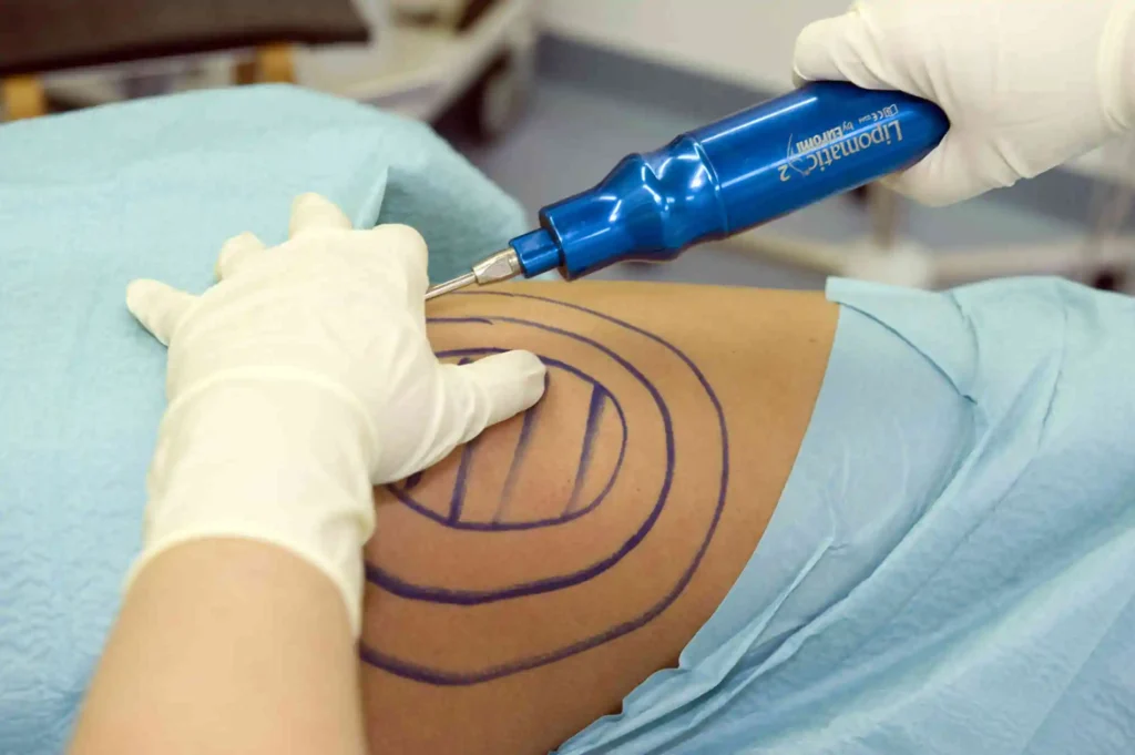 هل جلسات إذابة الدهون مضرة.. ما هي مخاطر حقن إذابة الدهون؟