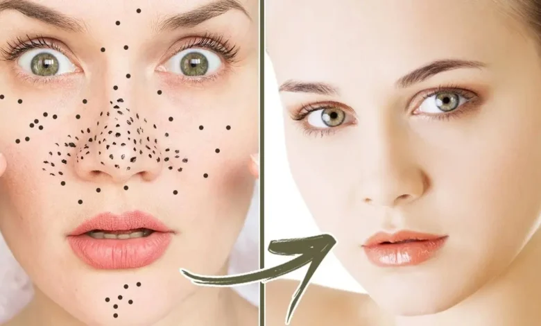 وصفة طبيعية للتخلص من الرؤوس السوداء في الوجه