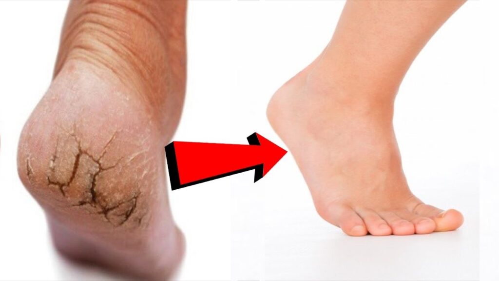 ازاي أعمل تقشير القدم من الأسفل في البيت؟