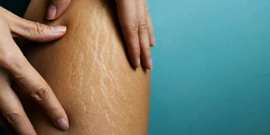 هل الرجل ينفر من السيلوليت؟ 2 هل الرجل ينفر من السيلوليت؟