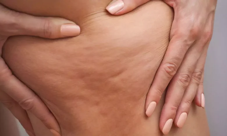 هل الرجل ينفر من السيلوليت؟