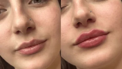 هل الفيلر للشفايف مضر للحامل؟