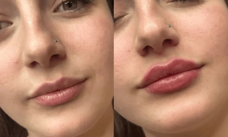 هل الفيلر للشفايف مضر للحامل؟