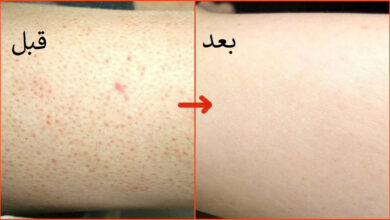 وصفة طبيعية لإزالة جلد الوزة بسرعة