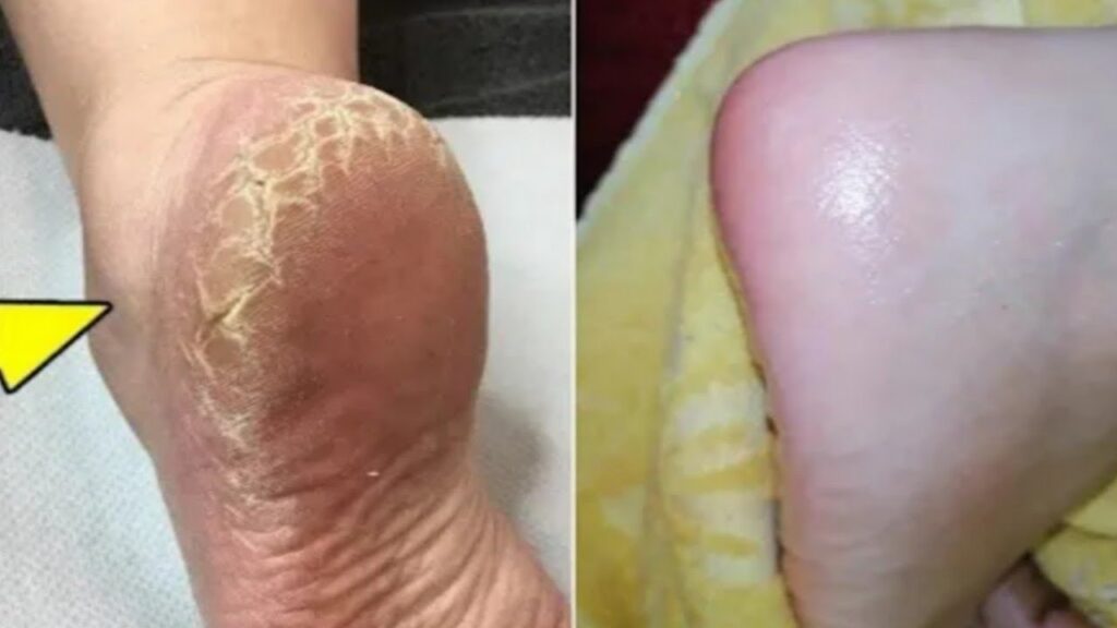 وصفة طبيعية لترطيب كعب القدمين والتخلص من الخشونة