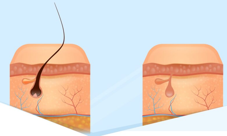 متى يبدأ مفعول التقشير الكيميائي للبكيني؟