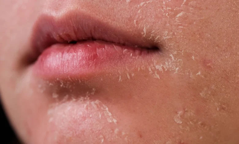 أهم أسباب جفاف البشرة في الشتاء وكيف تتغلبين عليها