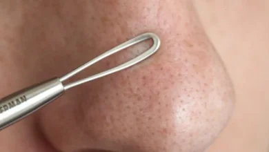 اكتشفي الماسك الذي يقضي على الرؤوس السوداء.. تجارب مذهلة وسريعة 8 اكتشفي الماسك الذي يقضي على الرؤوس السوداء.. تجارب مذهلة وسريعة