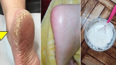 تخلصي من تشققات القدمين بسهولة في المنزل