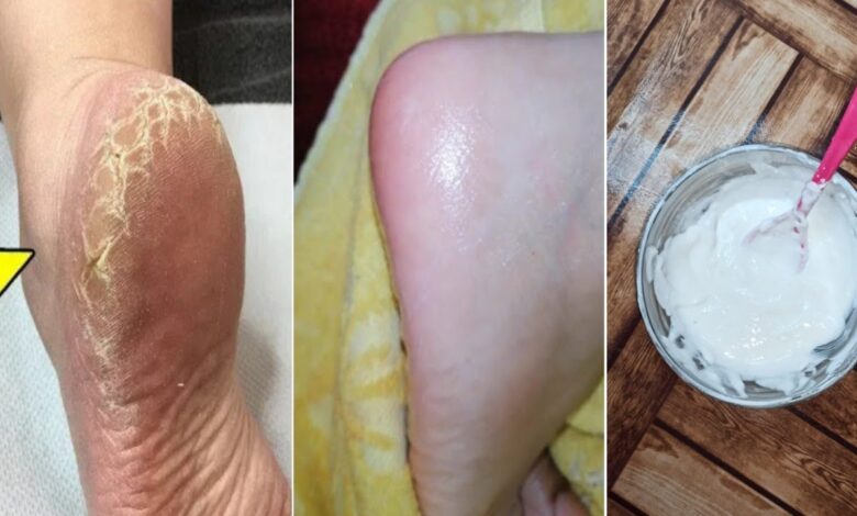تخلصي من تشققات القدمين بسهولة في المنزل