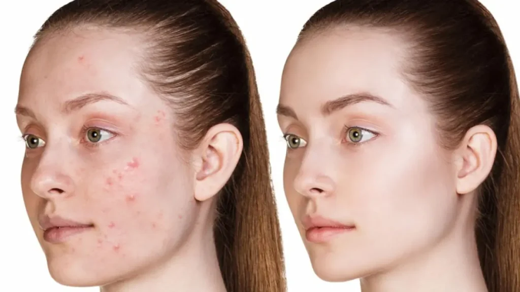 تخلصي من حبوب الوجه بسرعة قبل رأس السنة 2026