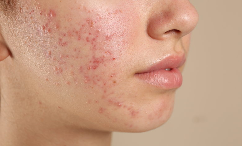 لماذا تظهر الحبوب تحت الجلد؟ وكيف تُعالج بدون ترك آثار؟