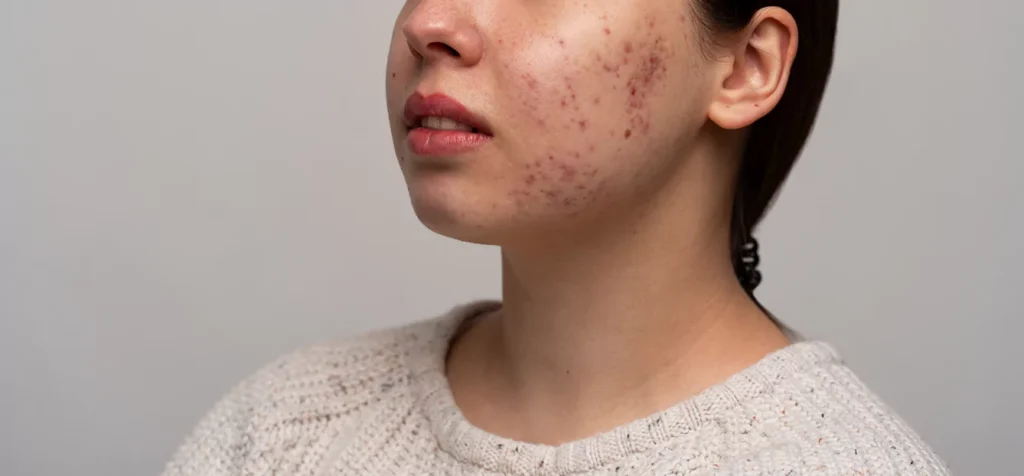 لماذا تظهر الحبوب تحت الجلد؟ وكيف تُعالج بدون ترك آثار؟