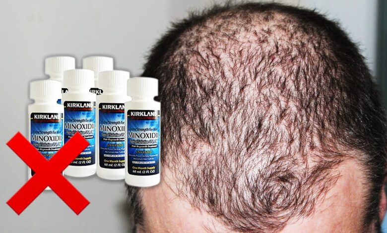 تجربتي مع المينوكسيديل للشعر.. متى تظهر نتائج المينوكسيديل