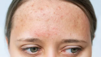 خطوات بسيطة للتخلص من حبوب الجبين الصغيرة واستعادة إشراقة بشرتك 5 خطوات بسيطة للتخلص من حبوب الجبين الصغيرة واستعادة إشراقة بشرتك