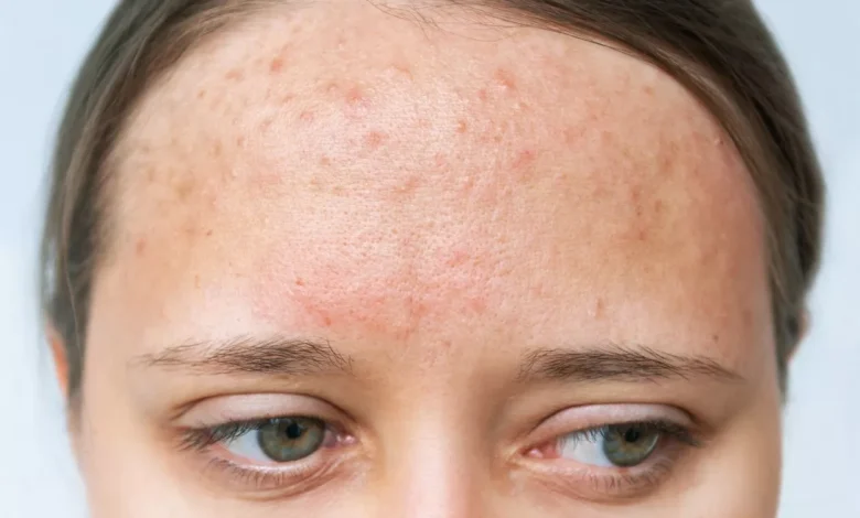 خطوات بسيطة للتخلص من حبوب الجبين الصغيرة واستعادة إشراقة بشرتك 1 خطوات بسيطة للتخلص من حبوب الجبين الصغيرة واستعادة إشراقة بشرتك