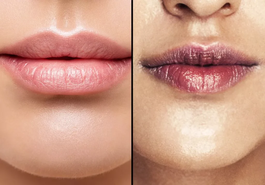 أسرع طريقة للتخلص من الاسمرار والسواد حول الفم