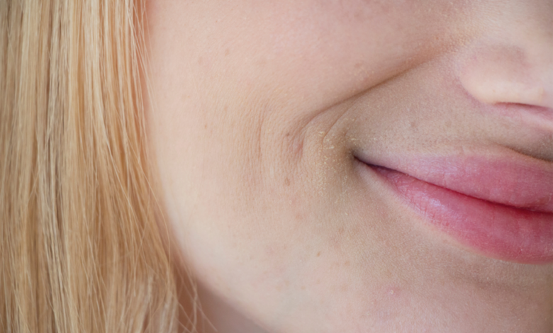 أسرع طريقة للتخلص من الاسمرار والسواد حول الفم