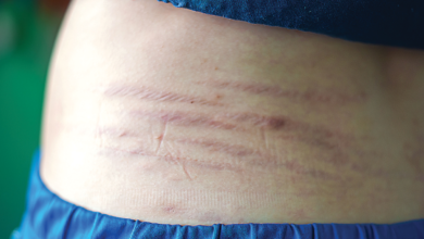 طرق طبيعية للتخفيف من علامات التمدد أثناء الحمل 7 طرق طبيعية للتخفيف من علامات التمدد أثناء الحمل