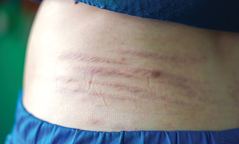 طرق طبيعية للتخفيف من علامات التمدد أثناء الحمل 1 طرق طبيعية للتخفيف من علامات التمدد أثناء الحمل