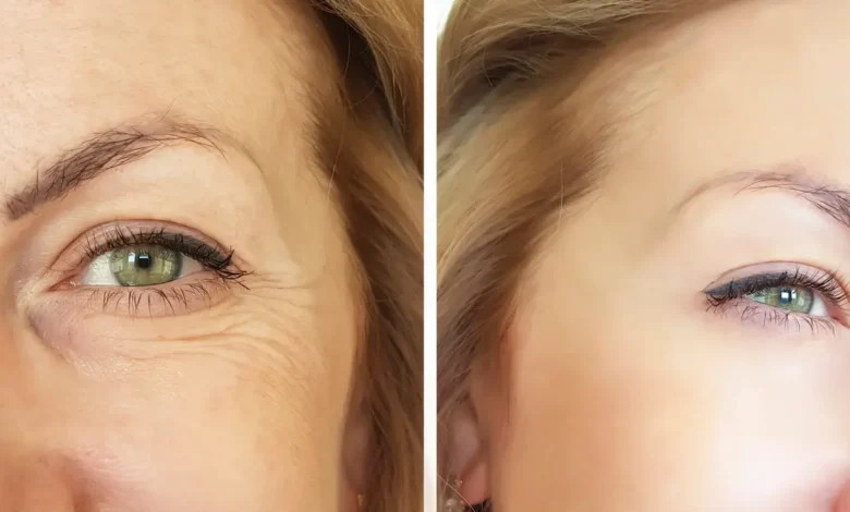 وداعًا للتجاعيد سريعًا: أفضل لاصقات العيون كبديل للبوتوكس 2026