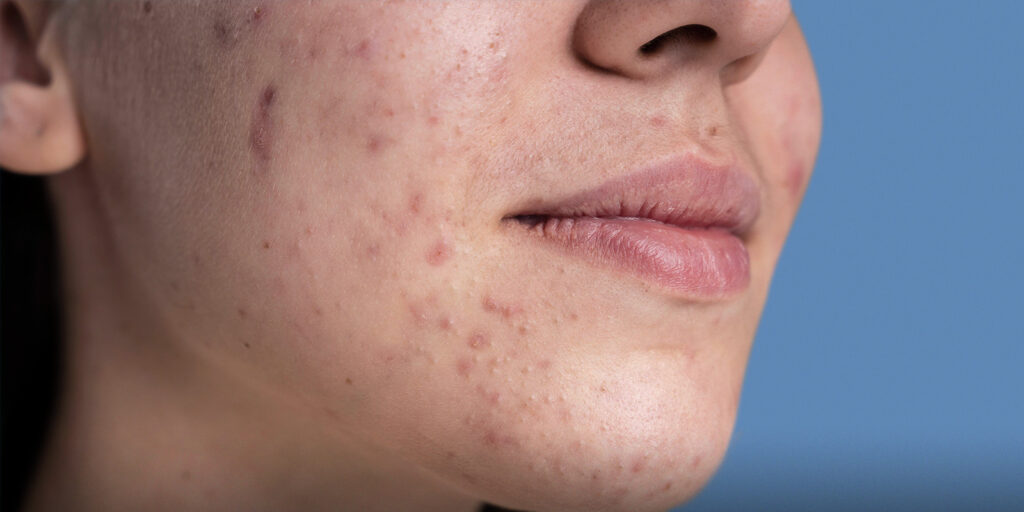 كيفية التخلص من حب الشباب للبشرة الدهنية
