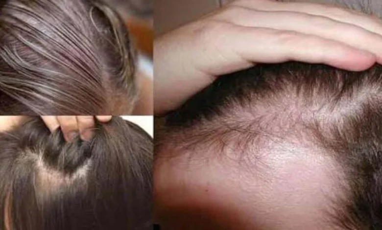 وصفة طبيعية في المنزل لملء الفراغات في الشعر.. كيف أعالج فراغات الشعر في البيت؟