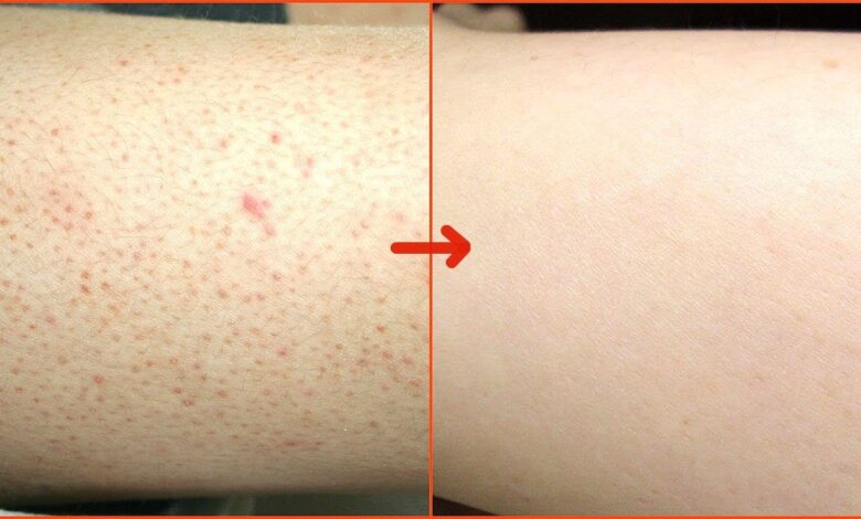 ازاي أتخلص من الشعر تحت الجلد نهائياً