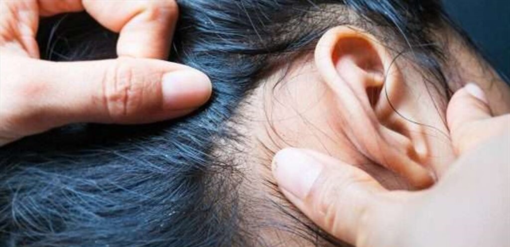 كيف أتخلص من القمل للشعر الطويل