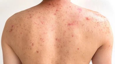ما أسباب ظهور حبوب الظهر عند النساء؟