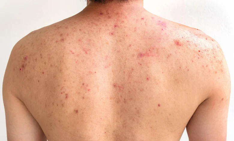 ما أسباب ظهور حبوب الظهر عند النساء؟