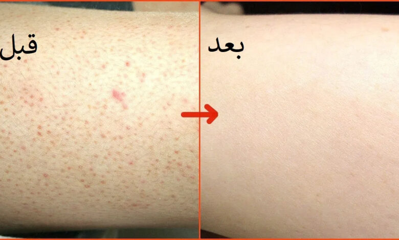 وصفة طبيعية لإزالة جلد الوزة بسرعة 1 وصفة طبيعية لإزالة جلد الوزة بسرعة