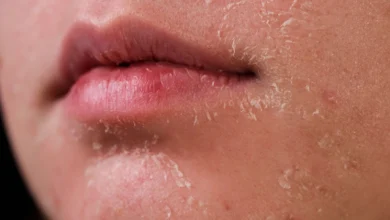 أهم أسباب جفاف البشرة في الشتاء وكيف تتغلبين عليها