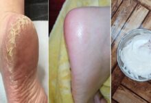 تخلصي من تشققات القدمين بسهولة في المنزل